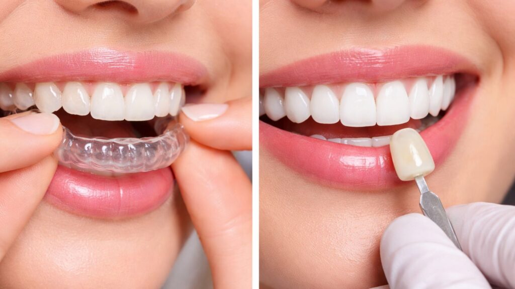 How Invisalign Aligner Trimlines Influence Gingival Response and Periodontal Tissue Health